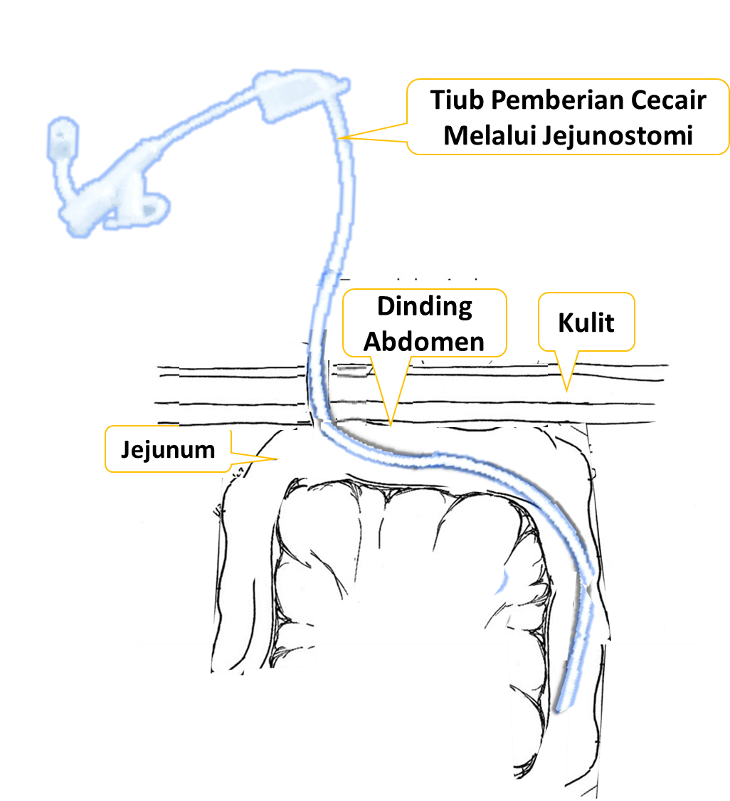 Pemberian Cecair Melalui Jejunostomi