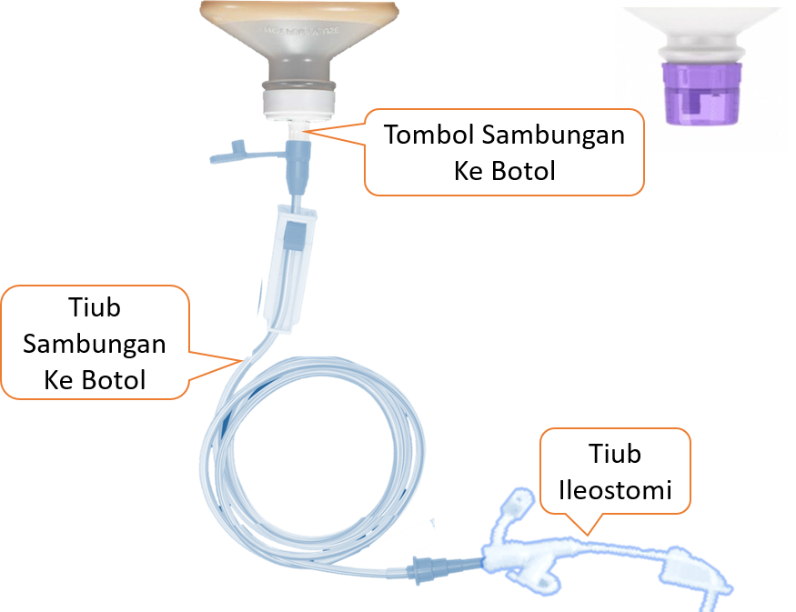 Sambungan Tiub dari Botol-Beg Makanan Cair Ke Ileostomi